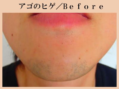 あごひげ脱毛Before