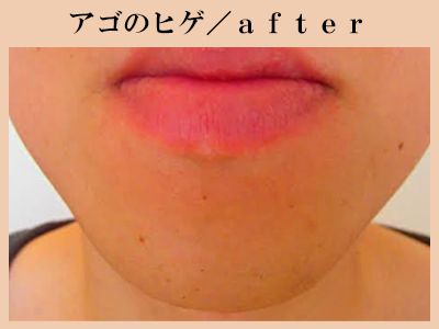 あごひげ脱毛After