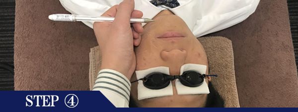あごヒゲ脱毛Step4