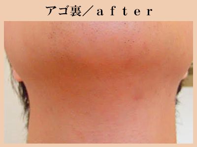 あご裏脱毛後