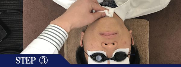 あご裏ヒゲ脱毛Step3