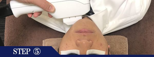 あご裏ヒゲ脱毛Step5