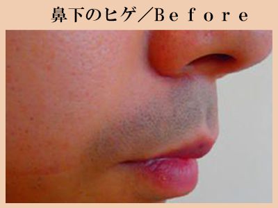 鼻下ヒゲ脱毛前