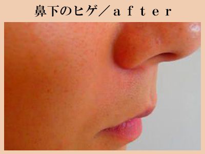 鼻下ヒゲ脱毛後