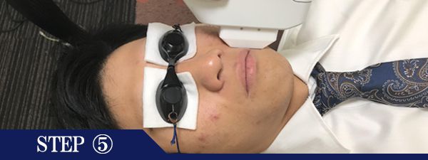 鼻下ヒゲ脱毛Step5