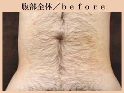 腹部の脱毛前