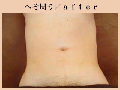 へそ周り脱毛後