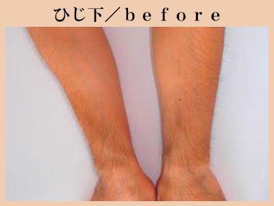 ひじ下の脱毛前