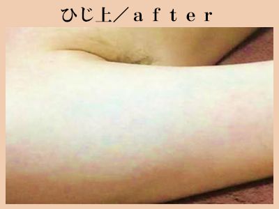 ひじ上の脱毛後