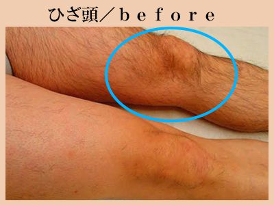 ひざ頭の脱毛前