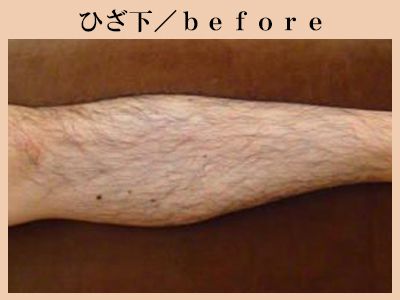 ひざ下の脱毛前