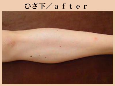 ひざ下の脱毛後