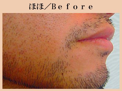 ほほの脱毛前
