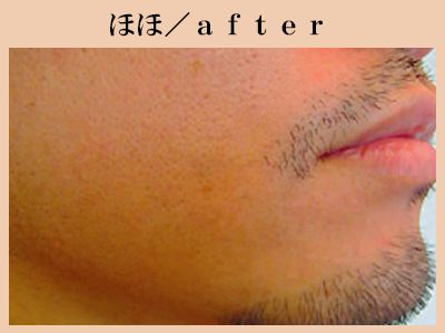 ほほ脱毛後
