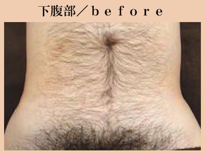 下腹部脱毛前