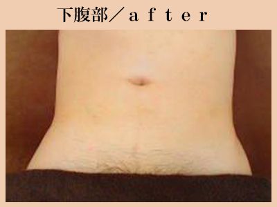 下腹部脱毛後