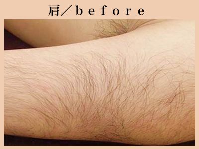 肩の脱毛前