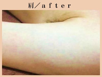 肩の脱毛後