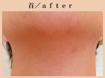 首脱毛後