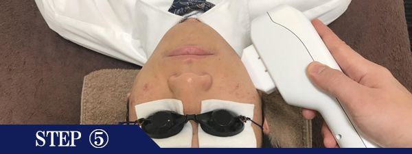 首脱毛Step5