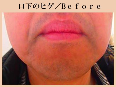 口下ヒゲ脱毛前