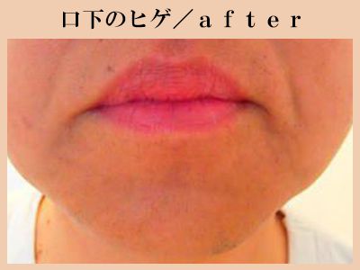 あごひげ脱毛After
