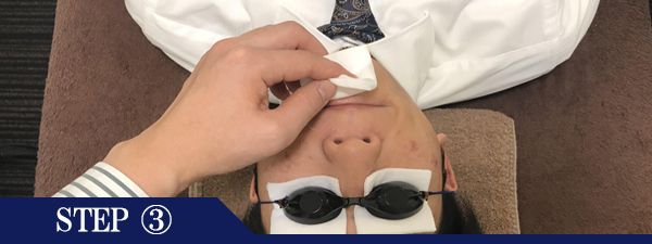 口下ヒゲ脱毛Step3