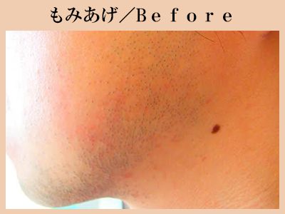 もみあげの脱毛前