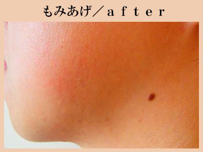 もみあげ脱毛後