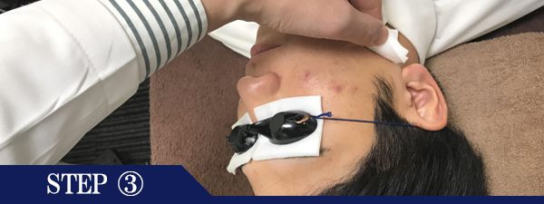 もみあげ脱毛Step3