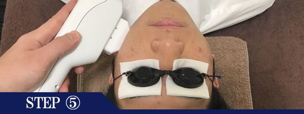 もみあげ脱毛Step5