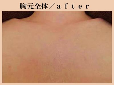胸元の脱毛後