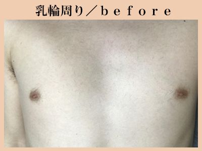 乳輪周り脱毛前