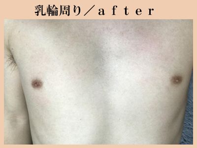 乳輪周り脱毛後