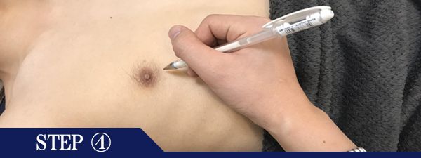 乳輪周りの脱毛Step4