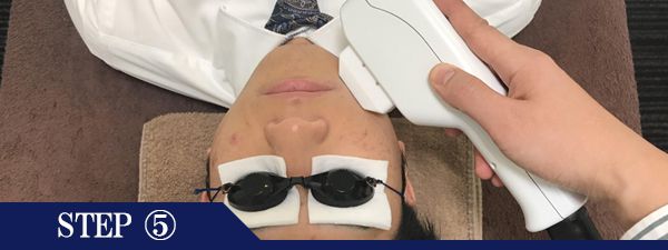 おでこ・眉間脱毛Step5