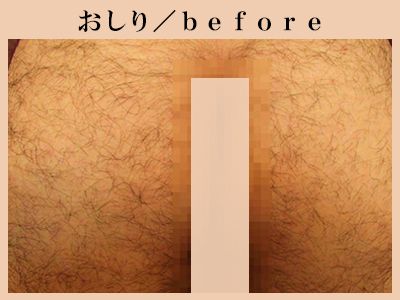 おしりの脱毛前
