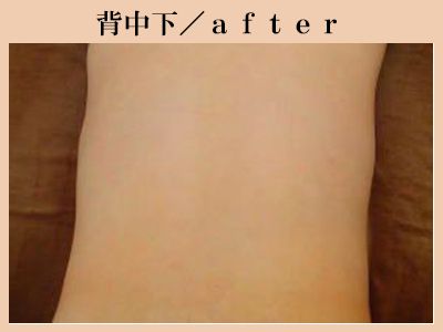 背中下の脱毛後