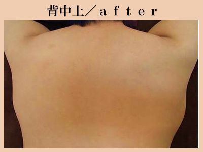 背中上の脱毛後