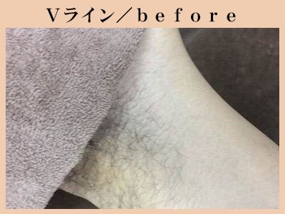 Ｖラインの脱毛前