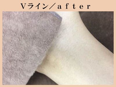 Ｖラインの脱毛後