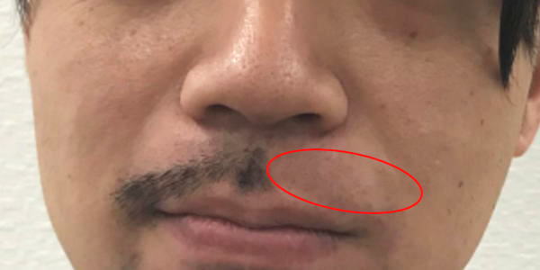 ヒゲ脱毛効果後